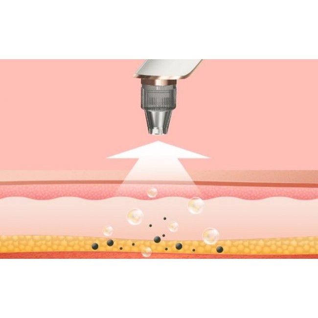 Уред за лице и тяло ANLAN X7 blackhead remover ALHTY03-01R Уред за премахване на черни точки
